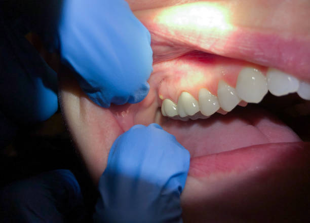 Best Emergency Treatment for Toothache in Scottsbluff, NE